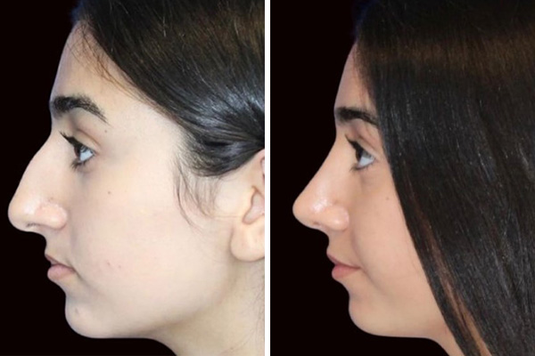 before and after results left side female patient