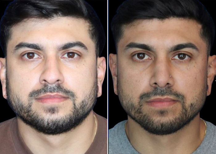 before and after results male ethnic rhinoplasty front view