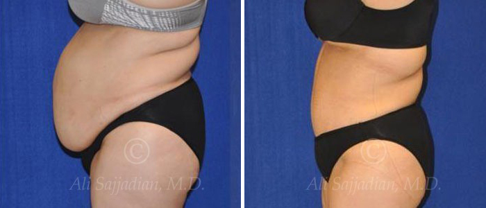 before and after tummy tuck female patient left side view
