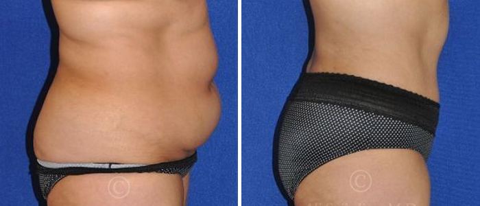 before and after tummy tuck female patient right side view