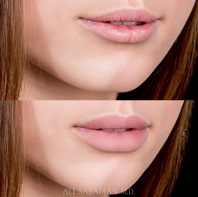 before and after lip augmentation results female patient