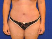 after front view tummy tuck of female patient 8501