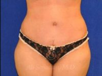 after front view tummy tuck of female patient 8501