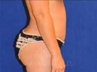after right view tummy tuck of female patient 8501