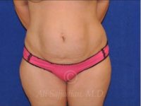 before front view tummy tuck of female patient 8501