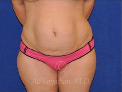 before front view tummy tuck of female patient 8501