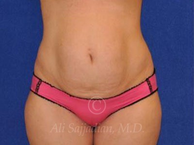 before front view tummy tuck of female patient 8501