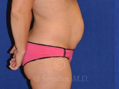 before right side view tummy tuck of female patient 8501