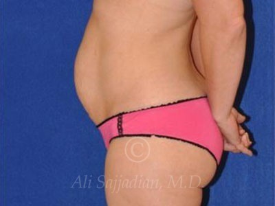 before left side view tummy tuck of female patient 8501