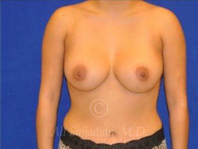 after breast augmentation front view case 8863