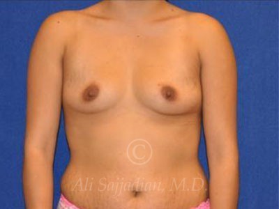 before breast augmentation front view case 8863