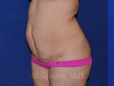 before tummy tuck female patient left angle view case 8877