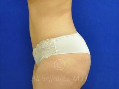 after tummy tuck female patient left side view case 8877