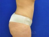 after tummy tuck female patient right side view case 8877