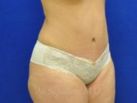 after tummy tuck female patient right angle case 8877