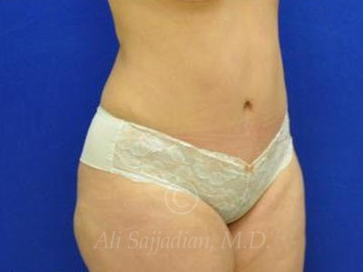 after tummy tuck female patient right angle case 8877