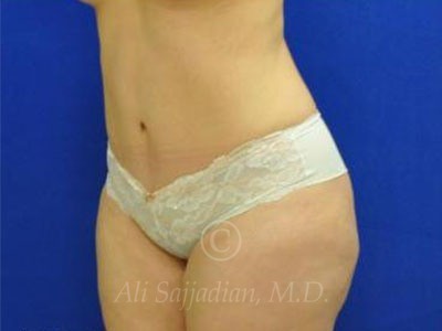 after tummy tuck female patient left angle view case 8877