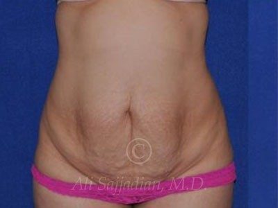 before tummy tuck female patient front view case 8877