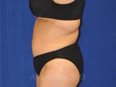 after tummy tuck female patient left side view case 8888
