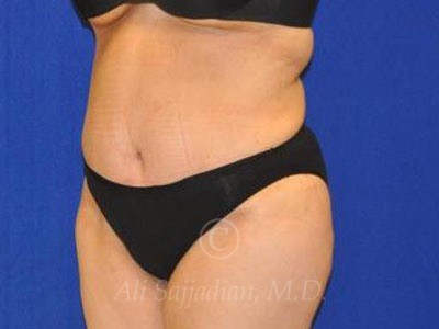 after tummy tuck female patient left angle view case 8888