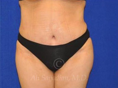 after tummy tuck female patient front view case 8888