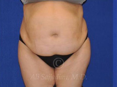 before tummy tuck female patient front view case 8888