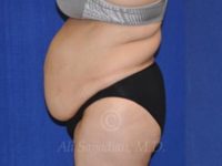 before tummy tuck female patient right side view case 8888