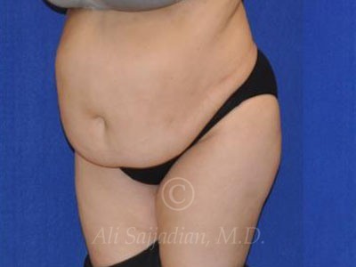 before tummy tuck female patient left angle view case 8888