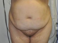 before tummy tuck female patient front view case 8888