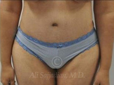 after tummy tuck female patient front view case 8897