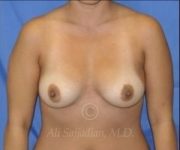 before breast augmentation front view case 8709