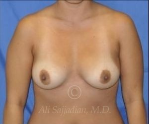 before breast augmentation front view case 8709