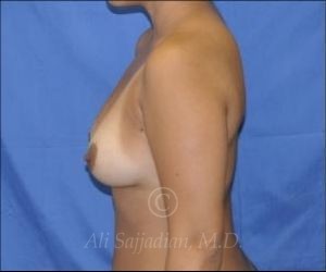 before breast augmentation side view case 8709