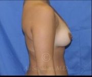 before breast augmentation side view case 8709