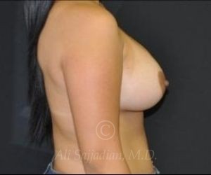 after breast augmentation side view case 8709