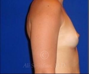 before breast augmentation side view case 8721