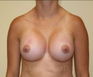 before breast augmentation front view case 8721