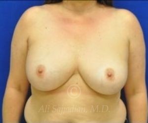 before breast augmentation front view case 8737