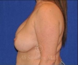 before breast augmentation side front view case 8737