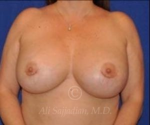 after breast augmentation angle front view case 8737