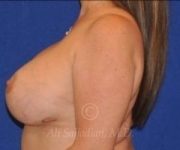 after breast augmentation left side case 8737
