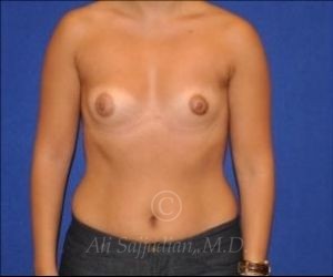 before breast augmentation front view cast 8759