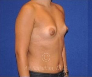 before breast augmentation right angle view case 8759