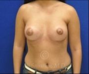 after breast augmentation front view case 8759