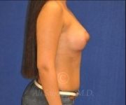 after breast augmentation side view case 8759