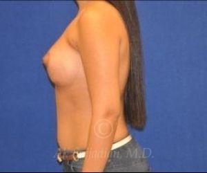 after breast augmentation left side view case 8759