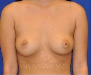 before breast augmentation front view case 8768