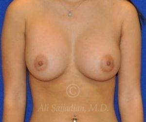 after breast augmentation front view case 8768