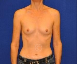 before breast augmentation front view case 8775