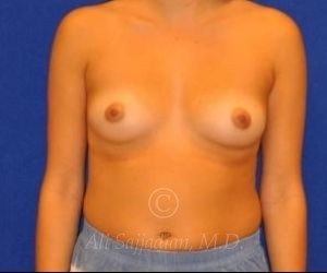 before breast augmentation front view case 8783